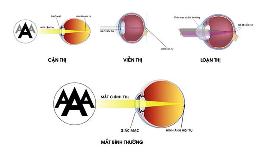 Cận thị có di truyền không khi trẻ dùng thiết bị điện tử nhiều