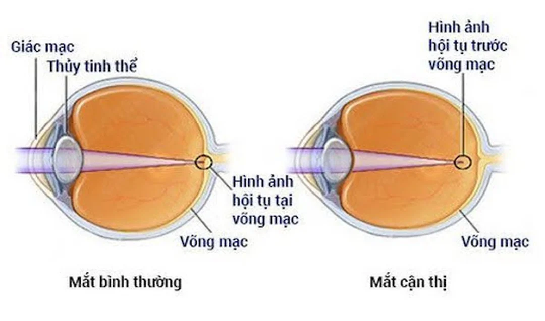 cận thị có tự khỏi được không theo nguyên lý hội tụ ánh sáng