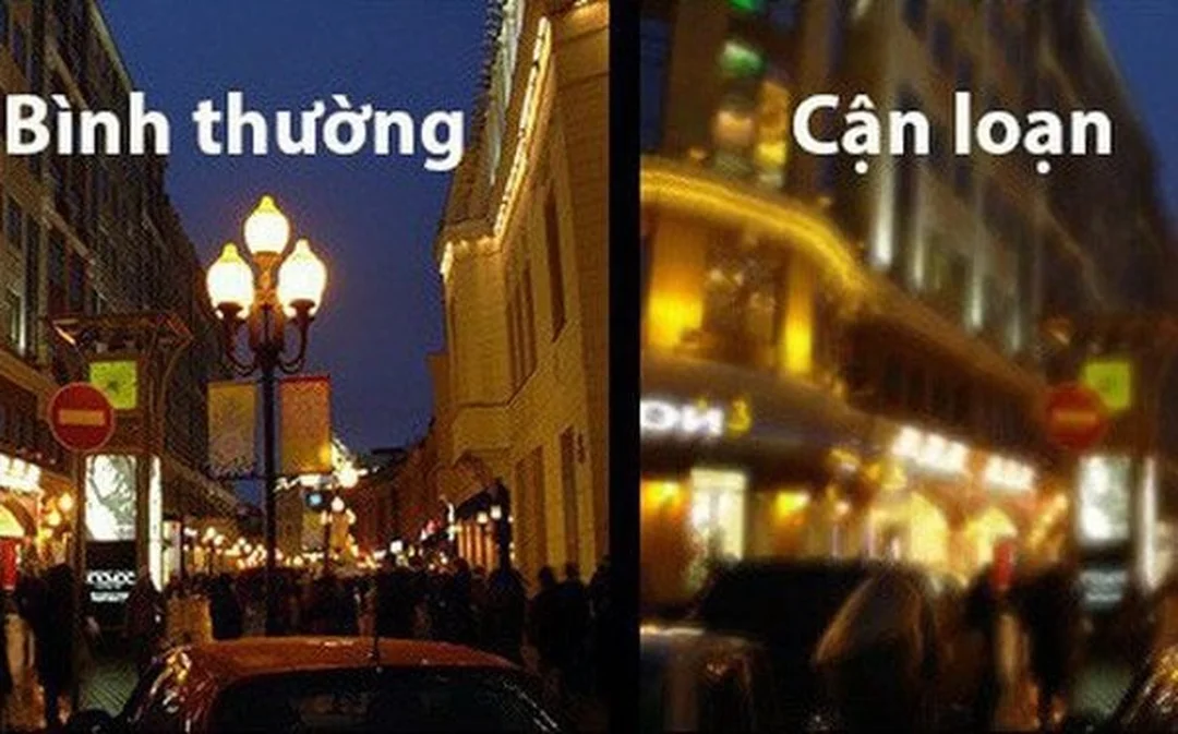 cận thị và loạn thị cần đo khúc xạ bằng thiết bị chuyên khoa