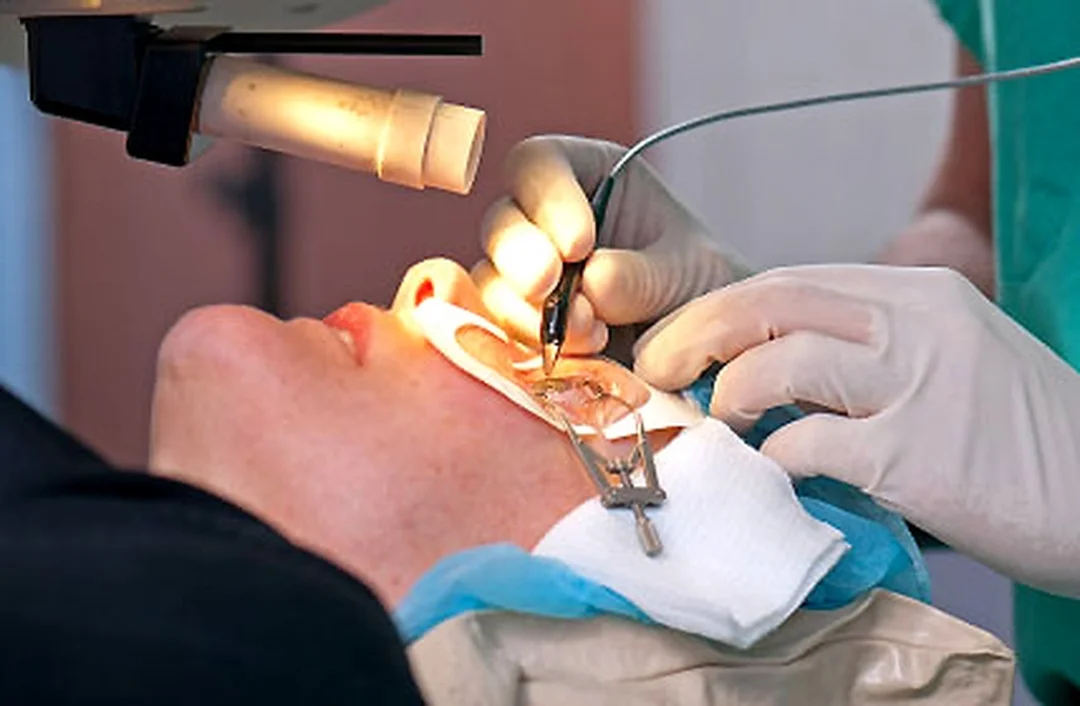 Phẫu thuật LASIK Femto LASIK ReLEx SMILE cho vừa cận thị vừa loạn thị Hình minh họa phẫu thuật điều chỉnh vừa cận thị vừa loạn thị bằng laser