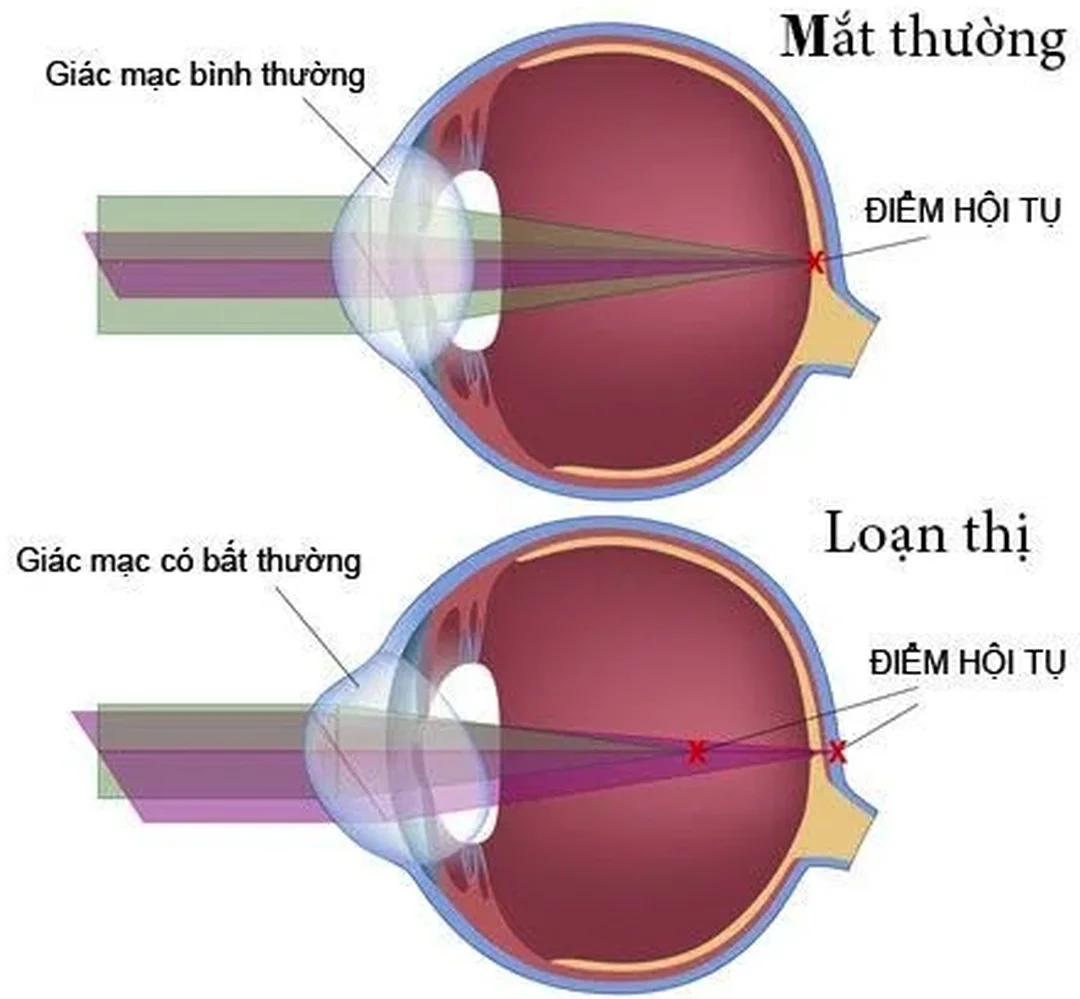 Loạn thị khác gì cận thị qua cơ chế hội tụ ánh sáng loạn thị khác gì cận thị qua sơ đồ giác mạc và điểm hội tụ ánh sáng