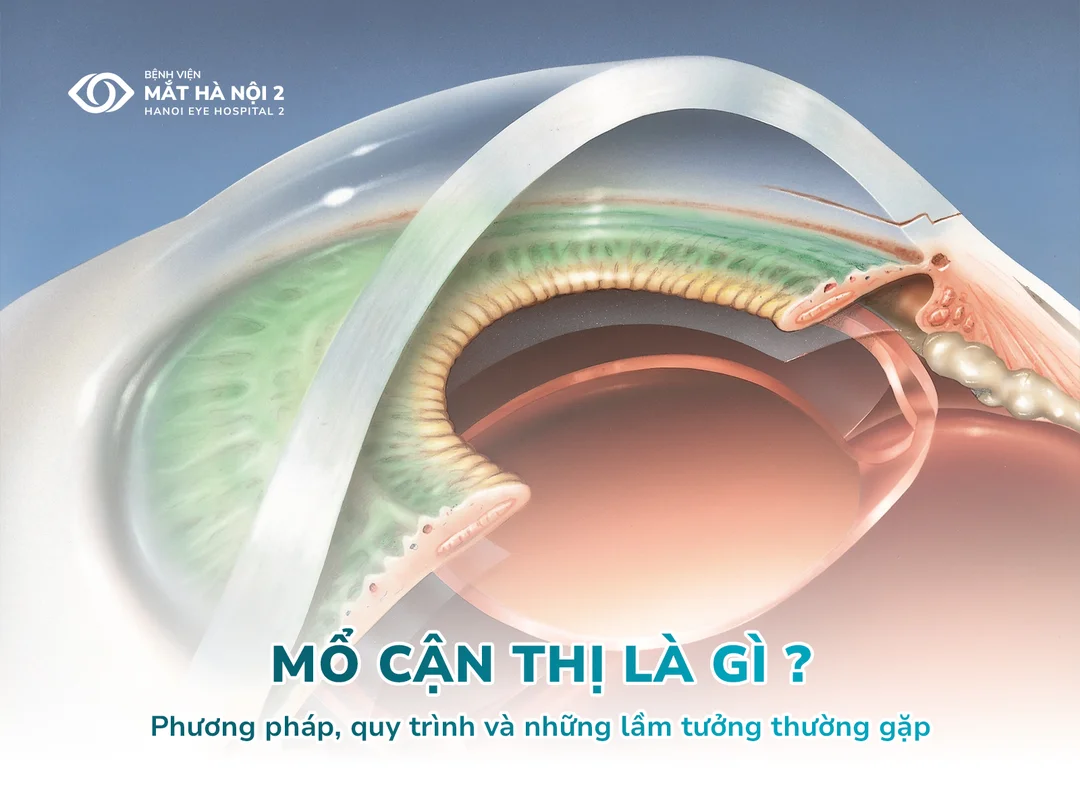 mổ cận thị là gì và có đáng làm không