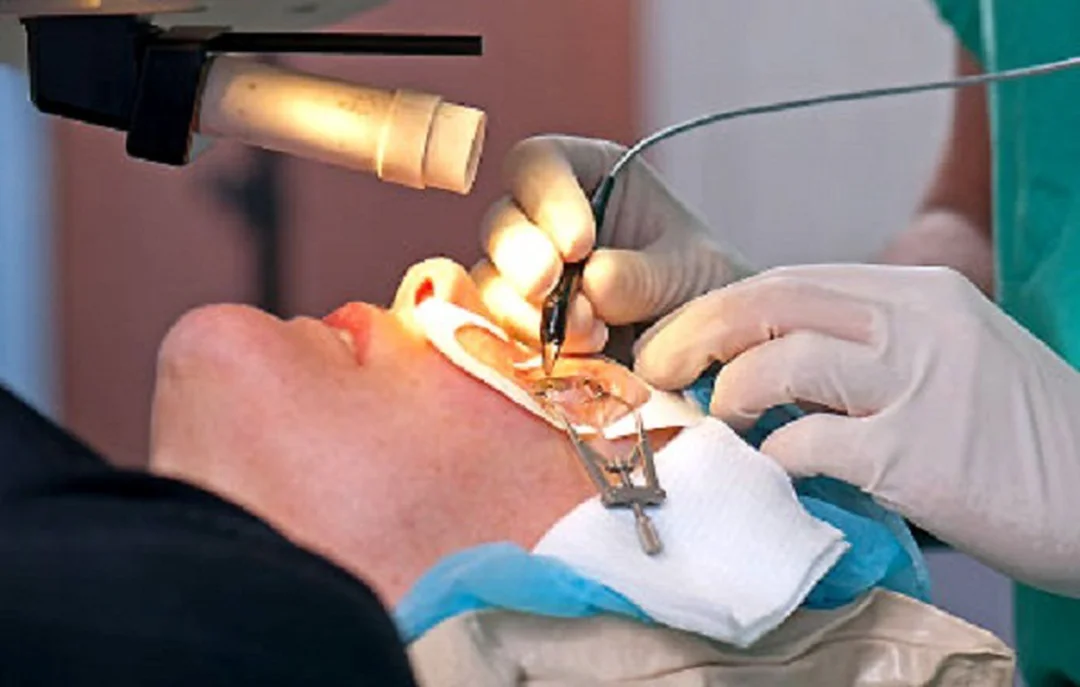 Phẫu thuật laser trong mổ mắt chữa cận thị mổ mắt chữa cận thị bằng laser trên giác mạc