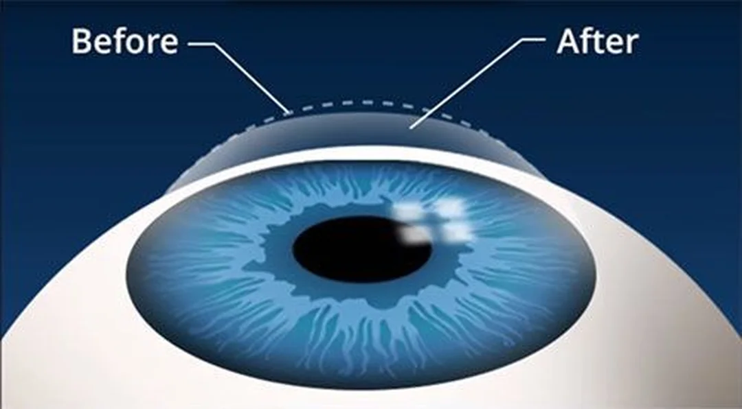 Chăm sóc sau mổ mắt chữa cận thị mổ mắt chữa cận thị cần chăm sóc và nhỏ thuốc sau phẫu thuật