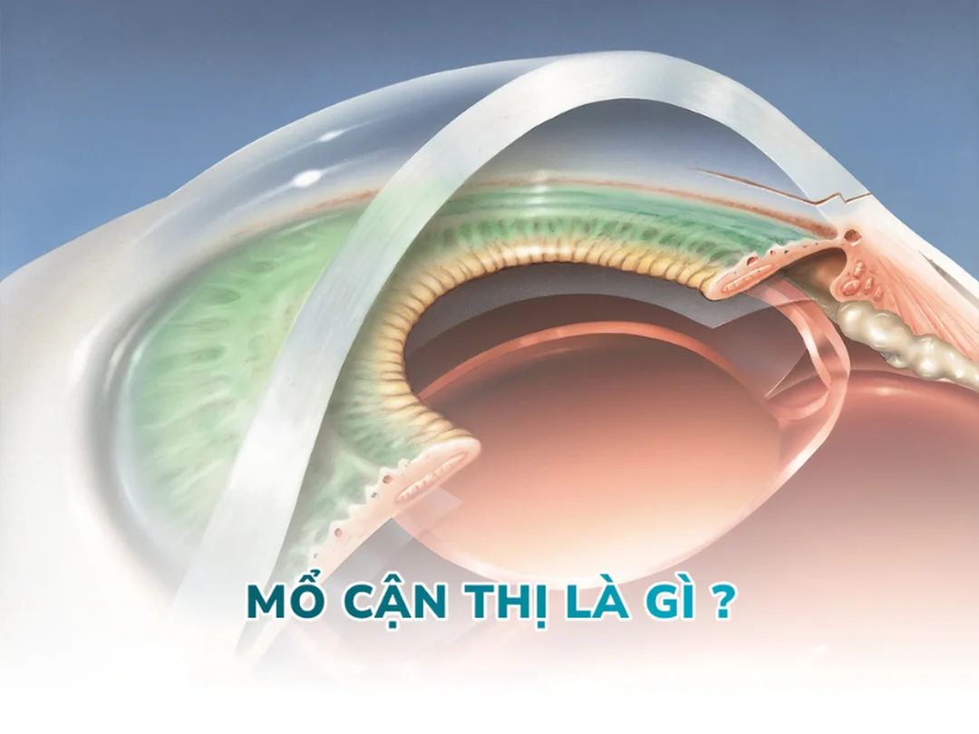 Mổ mắt chữa cận thị bằng LASIK cần giác mạc đủ điều kiện mổ mắt chữa cận thị cho người giác mạc mỏng cần cân nhắc kỹ