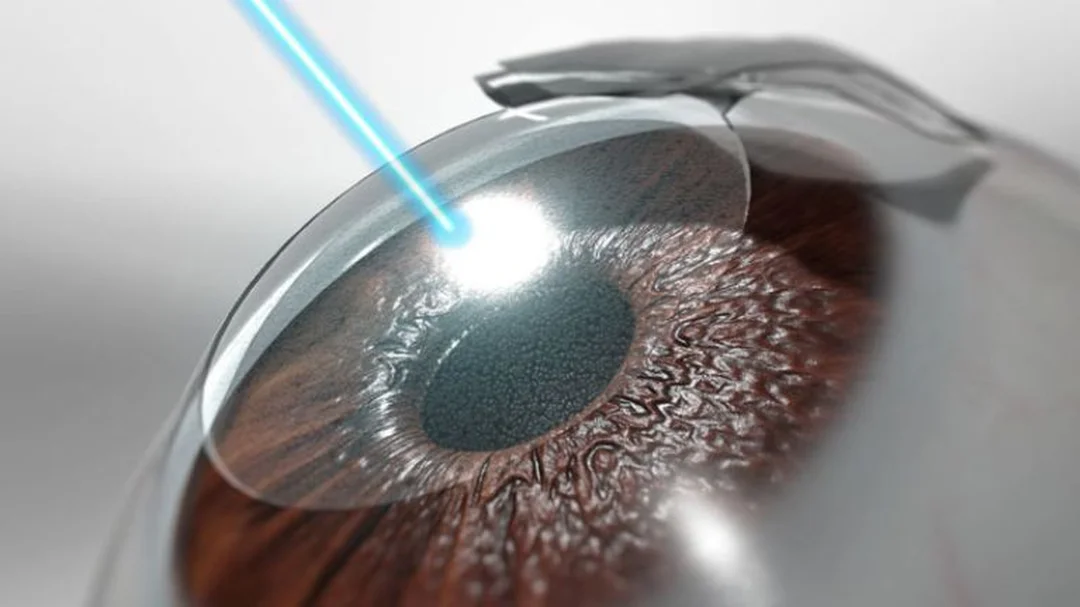 so sánh lasik femto lasik smile phẫu thuật lasik femto lasik smile điều trị cận thị