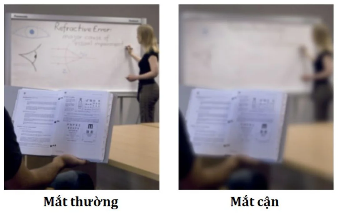 So sánh tầm nhìn mắt bình thường và mắt cận thị triệu chứng cận thị khi nhìn bảng xa bị mờ