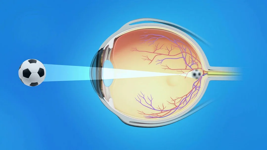 Video giải thích myopia từ kênh EyeSmart