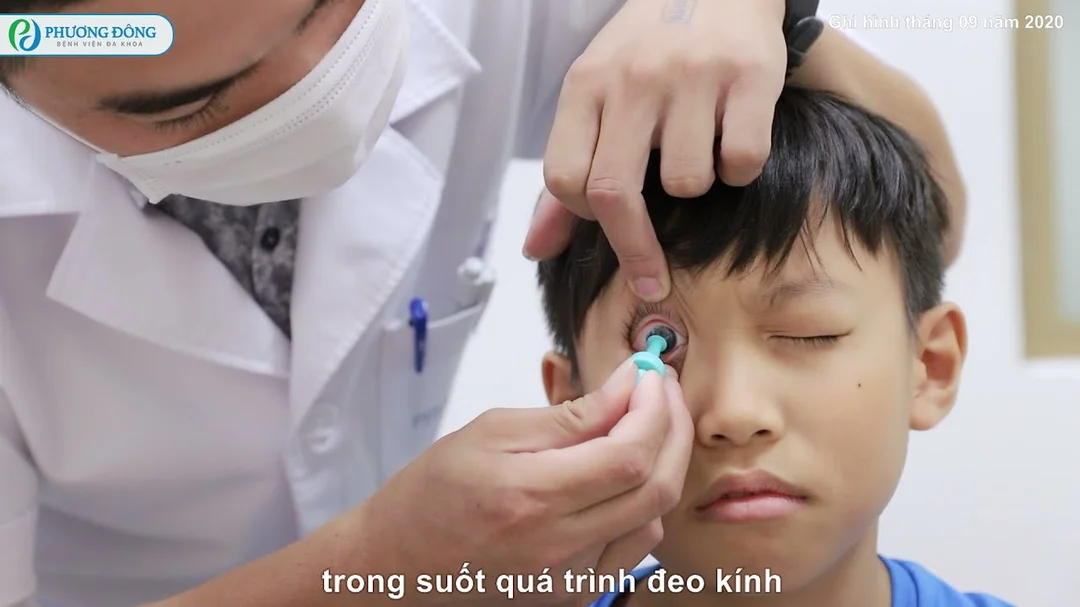 Video giải thích Ortho-K cho cận thị và loạn thị