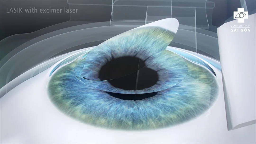 Video giải thích phương pháp xóa cận LASIK