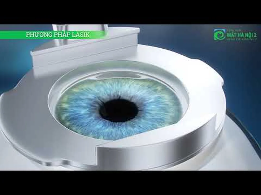 Video mô tả phương pháp mổ cận thị lasik