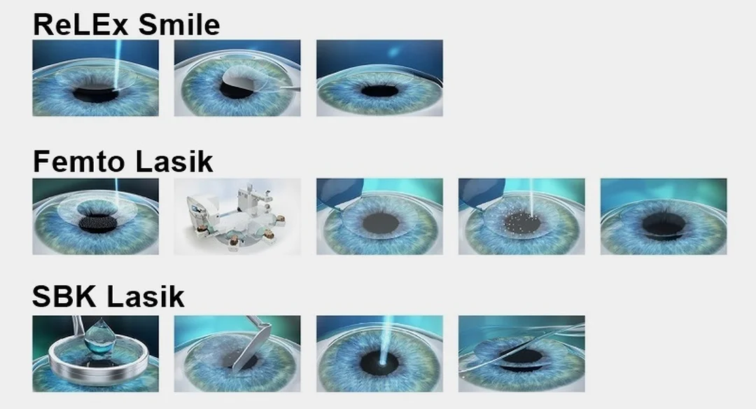 Tư vấn phẫu thuật laser điều trị cận thị bác sĩ tư vấn các phương pháp mổ cận thị bằng laser
