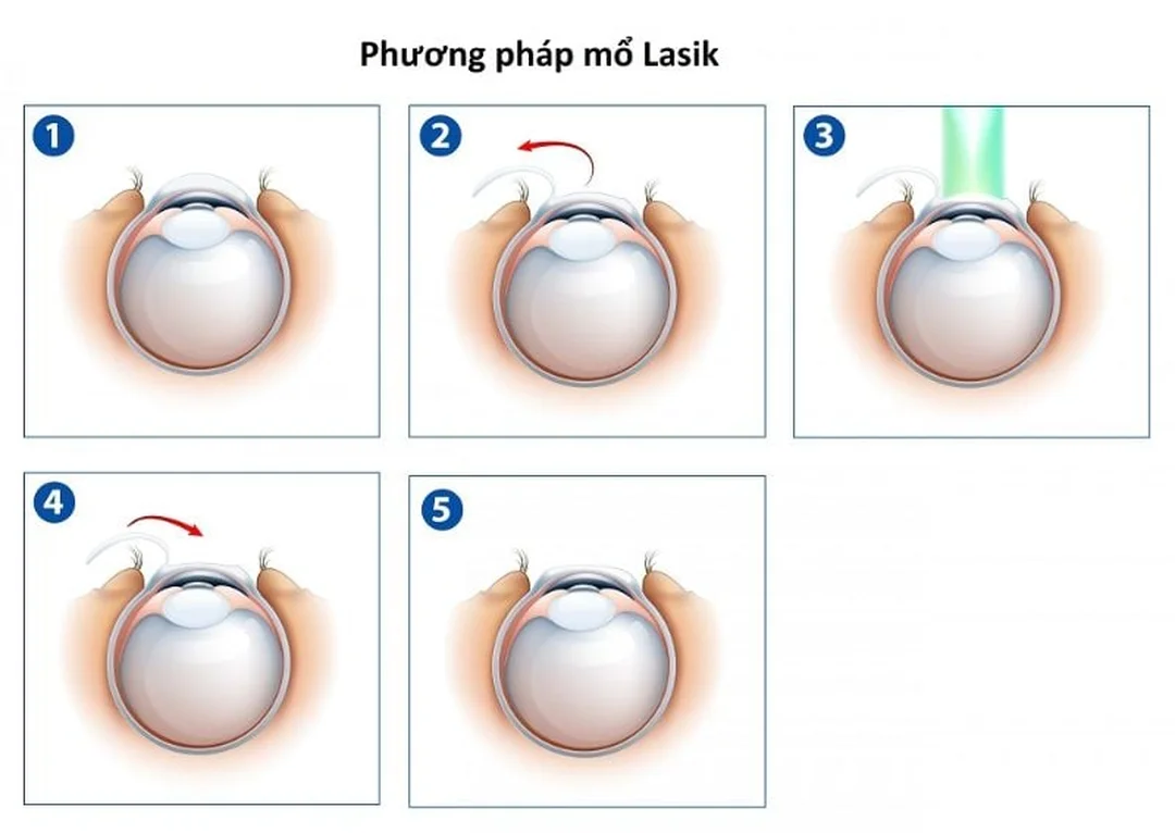LASIK trong bắn laser mắt cận thị bắn laser mắt cận thị bằng LASIK cần hiểu rõ rủi ro