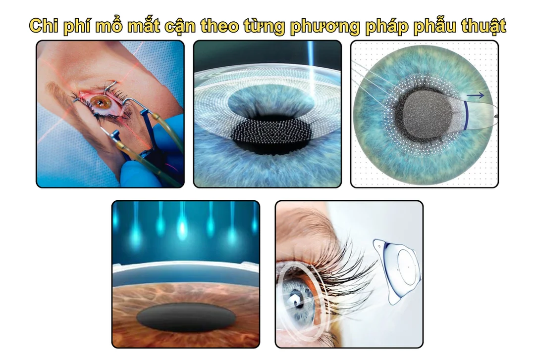 bắn mắt cận thị bao nhiêu tiền theo từng phương pháp phẫu thuật
