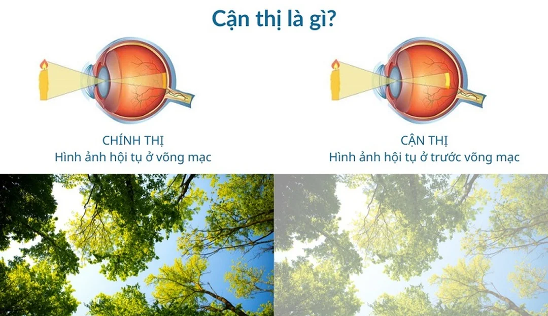 Bệnh cận thị có chữa được không bằng mẹo tại nhà bệnh cận thị có chữa được không bằng mẹo tại nhà