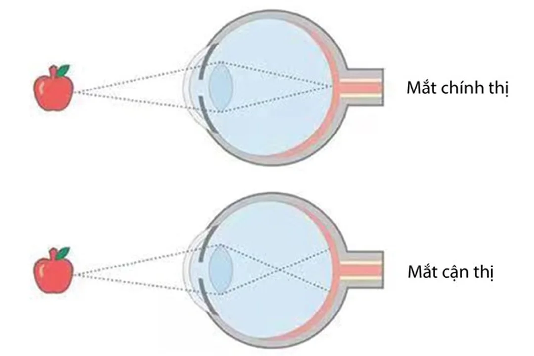 Khám định kỳ giúp theo dõi tiến triển cận thị biện pháp phòng tránh tật cận thị qua khám mắt định kỳ