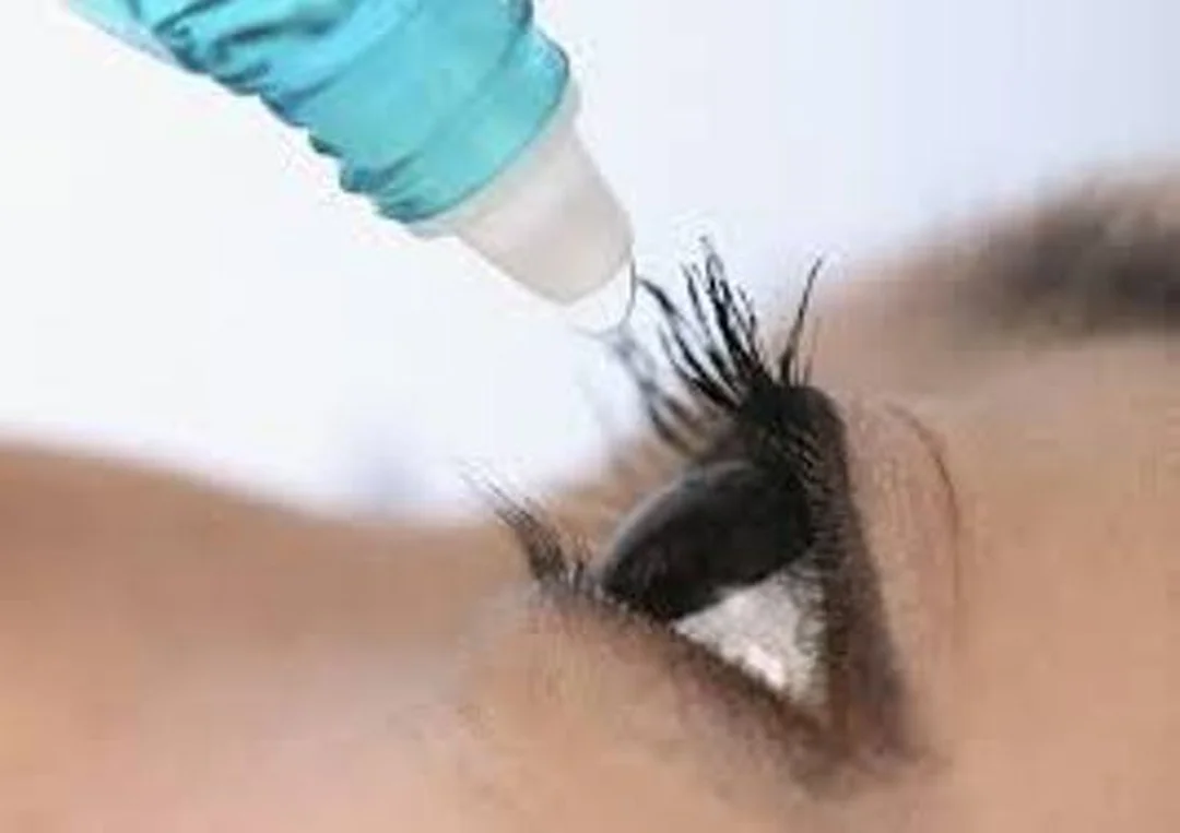 cách giả cận thị cần khám khúc xạ và nhỏ liệt điều tiết