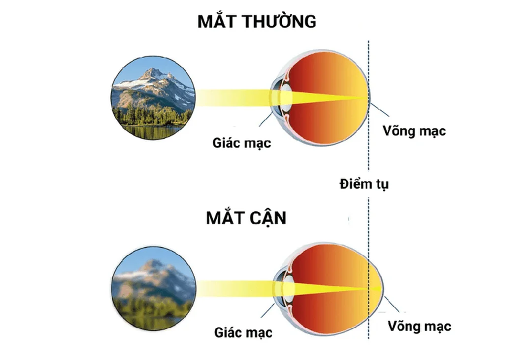 cận thị 1.5 diop có nên đeo kính