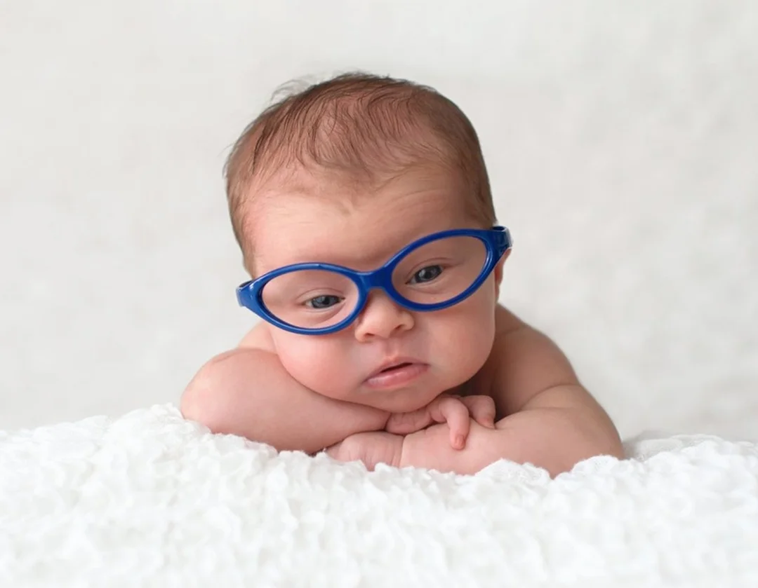 So sánh các phương pháp xử trí cận thị bẩm sinh cận thị bẩm sinh có chữa được không với kính gọng và Ortho-K
