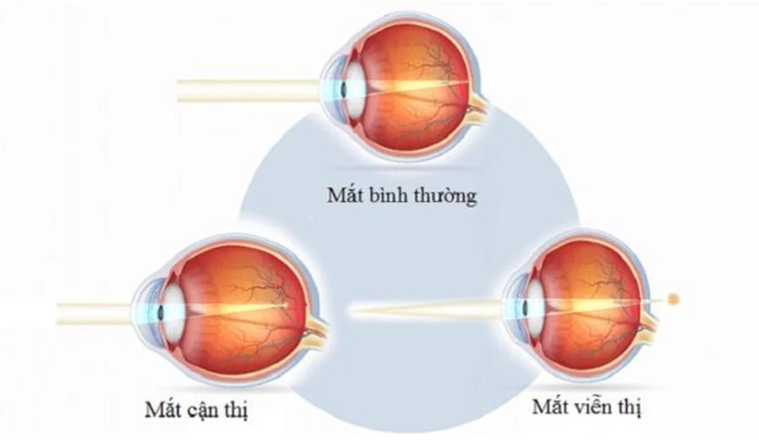 cận thị là sao khi so sánh mắt thường và mắt cận