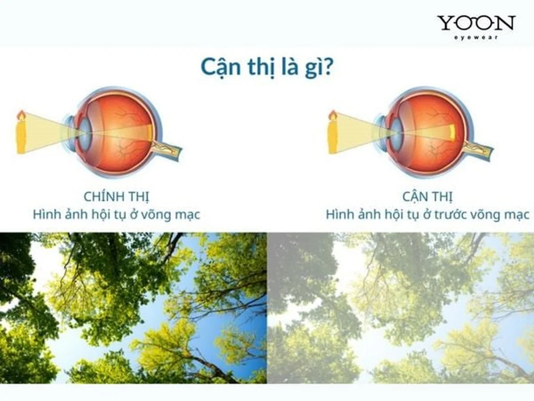 cận thị là sao qua bảng đo thị lực và số độ cận