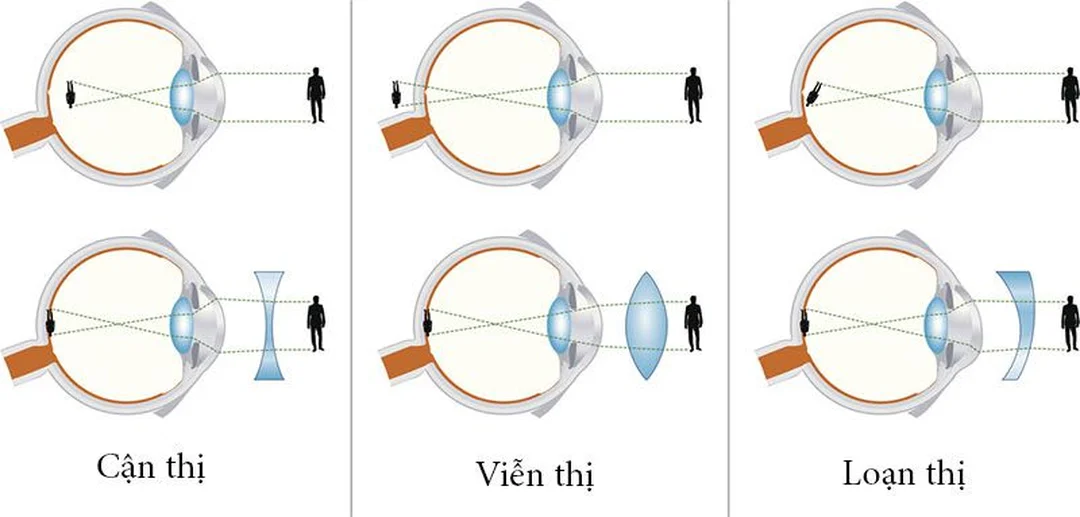 cận thị là sao qua biểu hiện nhìn xa mờ và nheo mắt