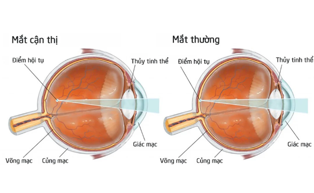cận thị nhìn như thế nào so với loạn thị và viễn thị