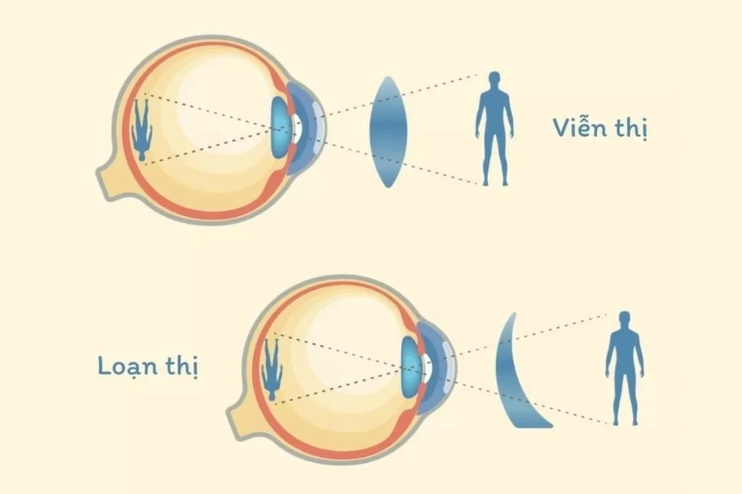 Cận thị và loạn thị khác nhau như thế nào qua tư vấn khám mắt chuyên khoa cận thị và loạn thị khác nhau như thế nào qua tư vấn khám mắt chuyên khoa