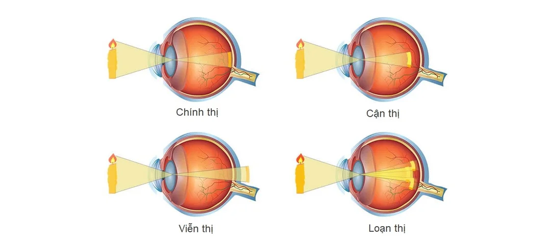 Câu hỏi thường gặp về bệnh cận thị tiếng Anh câu hỏi thường gặp về bệnh cận thị tiếng anh và tật khúc xạ