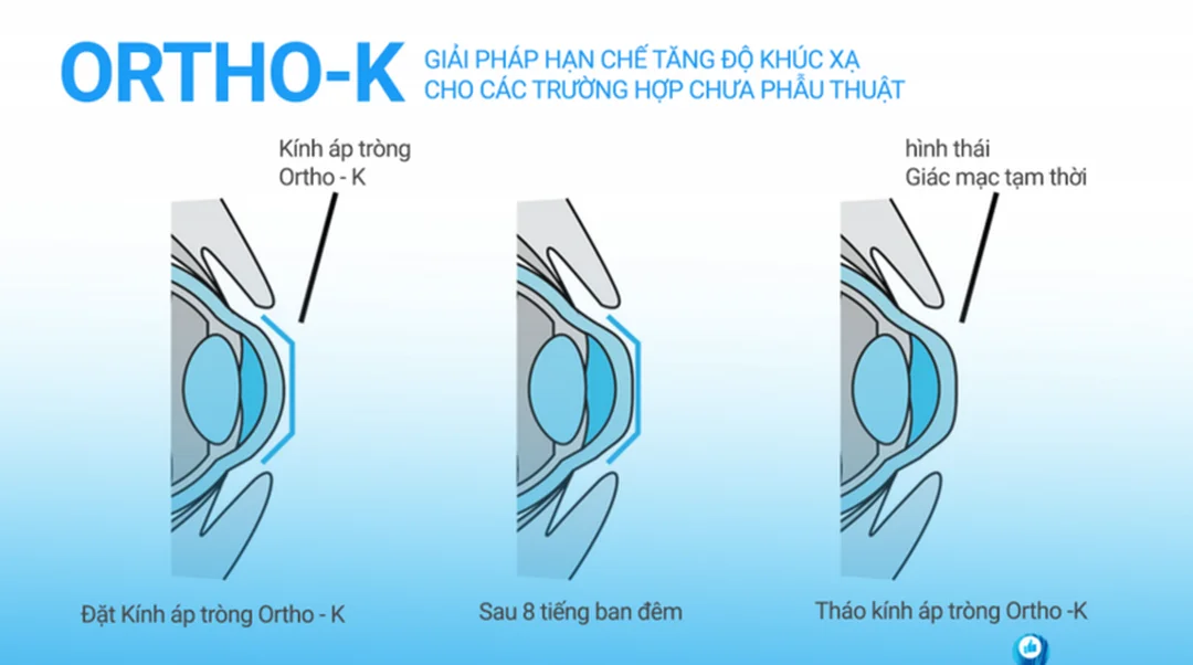 So sánh Ortho-K với các phương pháp kiểm soát cận thị chữa cận thị bằng kính đeo ban đêm so sánh với kính gọng và phương pháp khác
