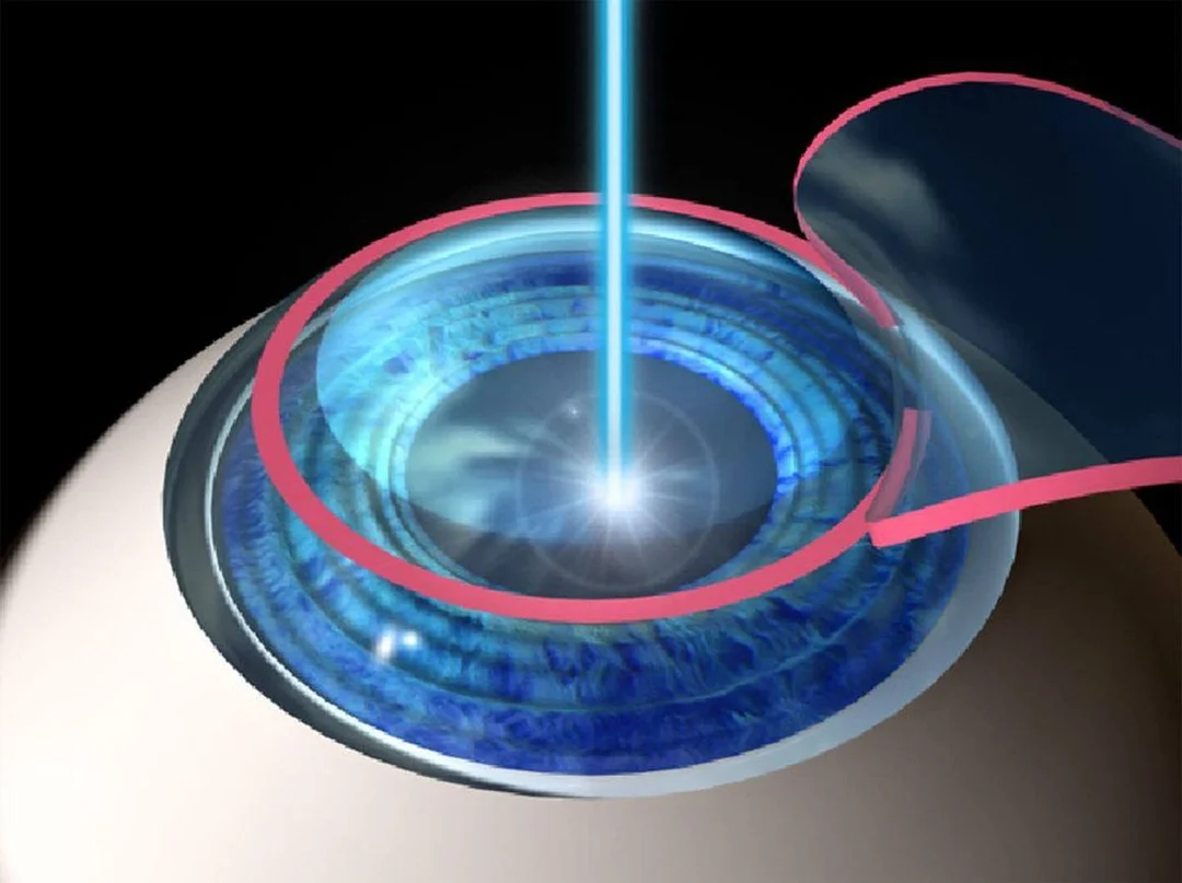 LASIK trong chữa cận thị bằng laser chữa cận thị bằng laser LASIK là phương pháp phổ biến trong điều trị tật khúc xạ