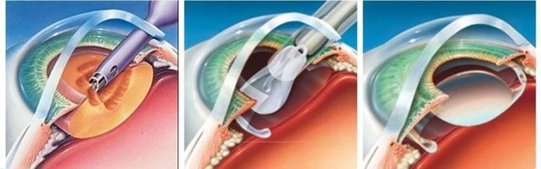 Tư vấn lựa chọn chữa cận thị bằng laser và phương pháp thay thế chữa cận thị bằng laser và lựa chọn thay thế bằng Intacs trong nhãn khoa