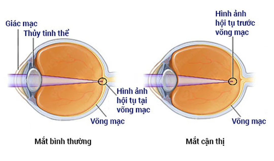 Dấu hiệu cần khám do nguyên nhân của tật cận thị Dấu hiệu cần khám khi nghi ngờ nguyên nhân của tật cận thị