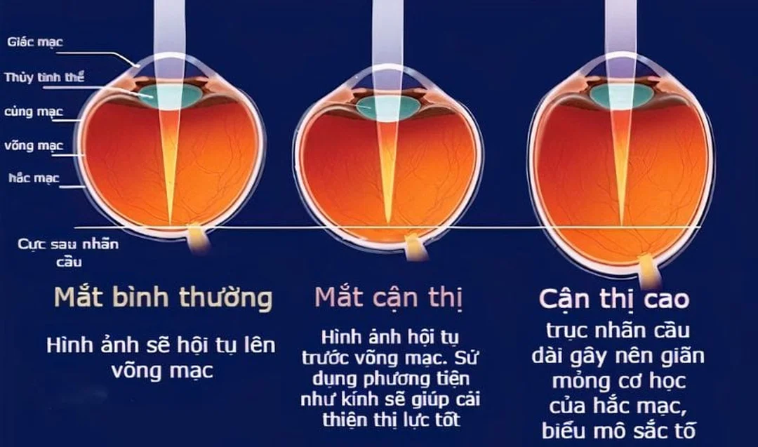 Các mức độ cận thị cần được phân loại đúng dấu hiệu độ cận thị ở trẻ em và người lớn