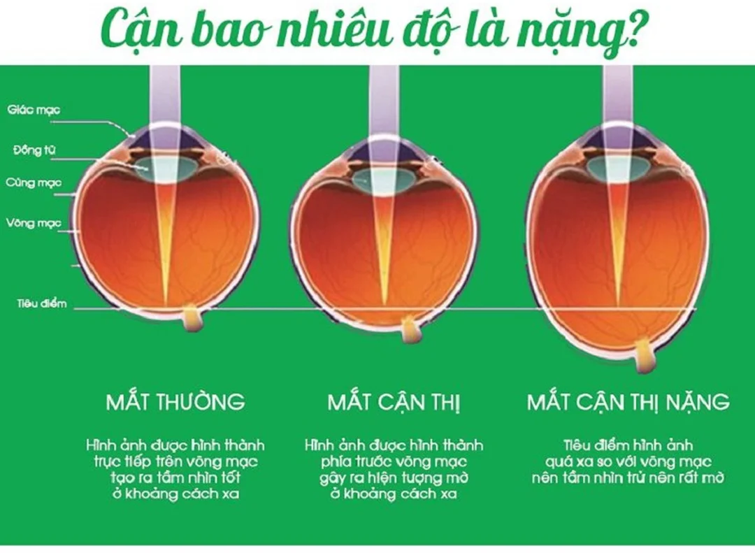 Khám mắt định kỳ để tìm nguyên nhân cận thị đâu là nguyên nhân gây ra cận thị cần được khám mắt định kỳ