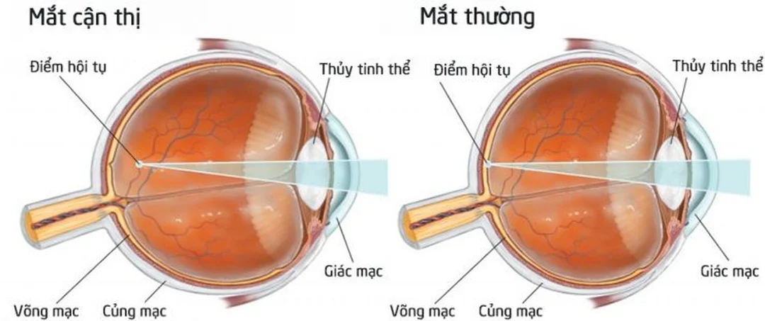 Di truyền và nguyên nhân của tật cận thị Di truyền là một nguyên nhân của tật cận thị nhưng không phải yếu tố duy nhất