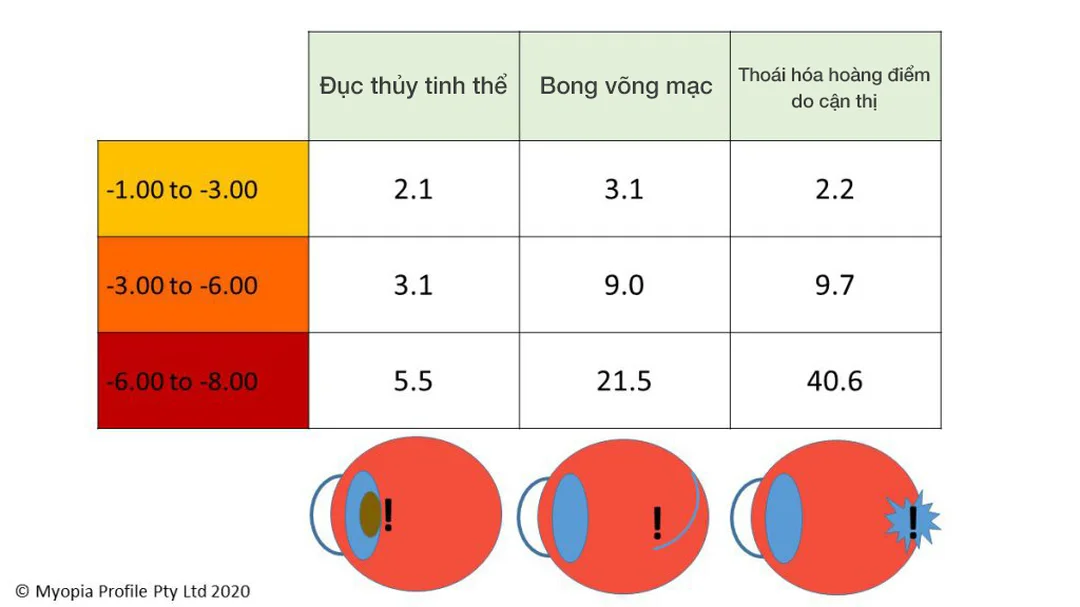 Nguy cơ của độ cận thị tăng nhanh nguy cơ tăng độ cận thị khi nhãn cầu dài ra