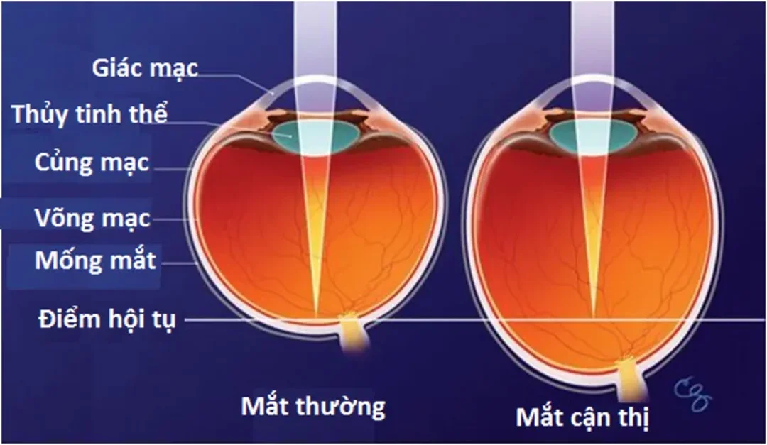 Cơ chế nhãn cầu dài trong bệnh cận thị Nhãn cầu dài hoặc giác mạc quá cong có thể gây bệnh cận thị