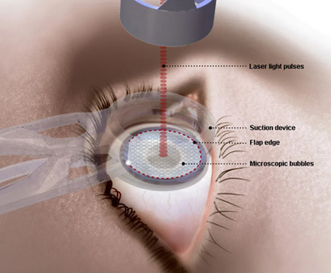 phẫu thuật cận thị lasik cần chăm sóc mắt và tái khám sau mổ