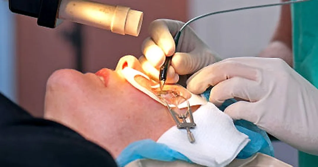 phẫu thuật cận thị lasik cần khám sàng lọc giác mạc trước mổ