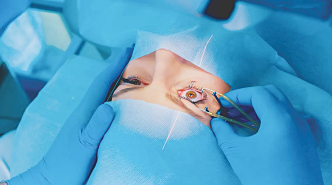 phẫu thuật cận thị lasik phù hợp với người có giác mạc đủ điều kiện