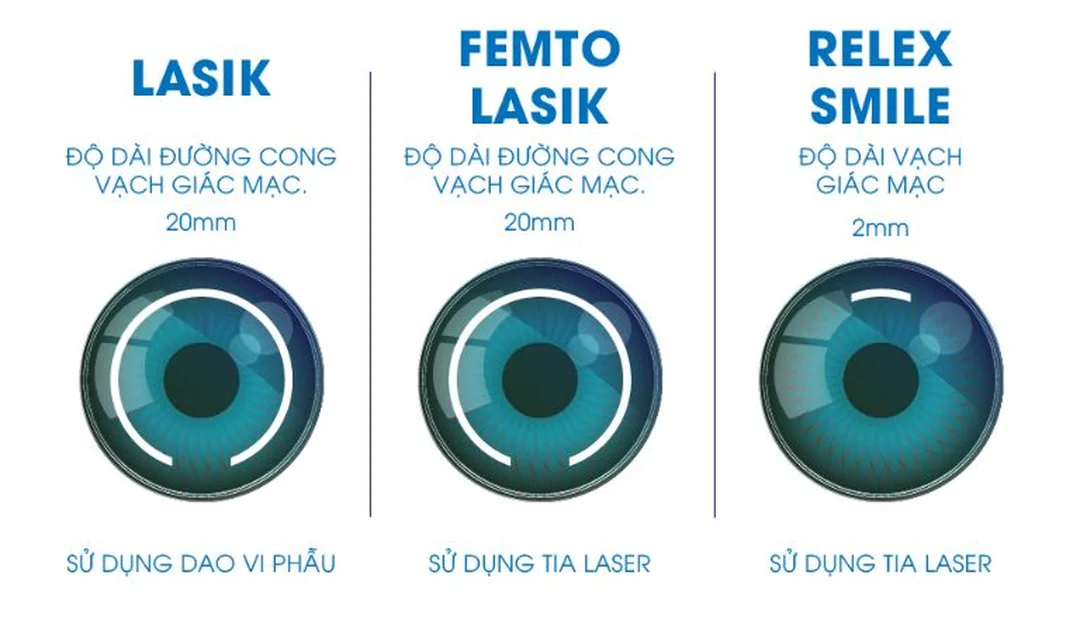 phẫu thuật cận thị lasik so sánh với smile và femto lasik