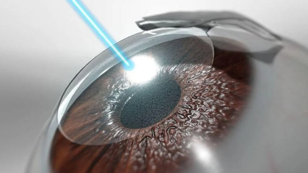 phẫu thuật cận thị lasik sử dụng laser điều chỉnh giác mạc