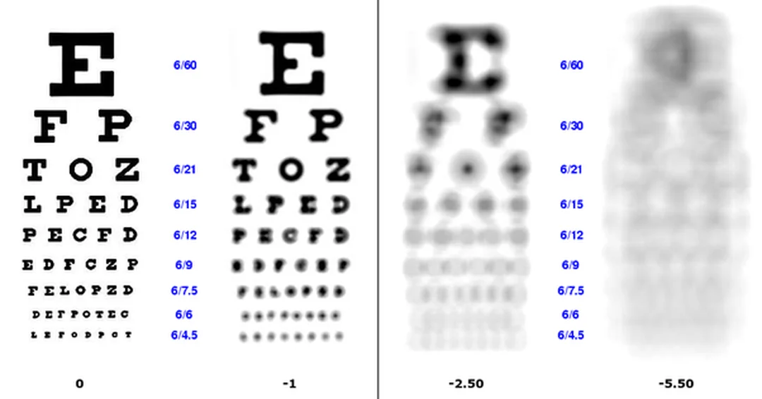 Sai lầm khi dùng từ tiếng Anh về cận thị sai lầm khi dịch bệnh cận thị tiếng anh sang myopia