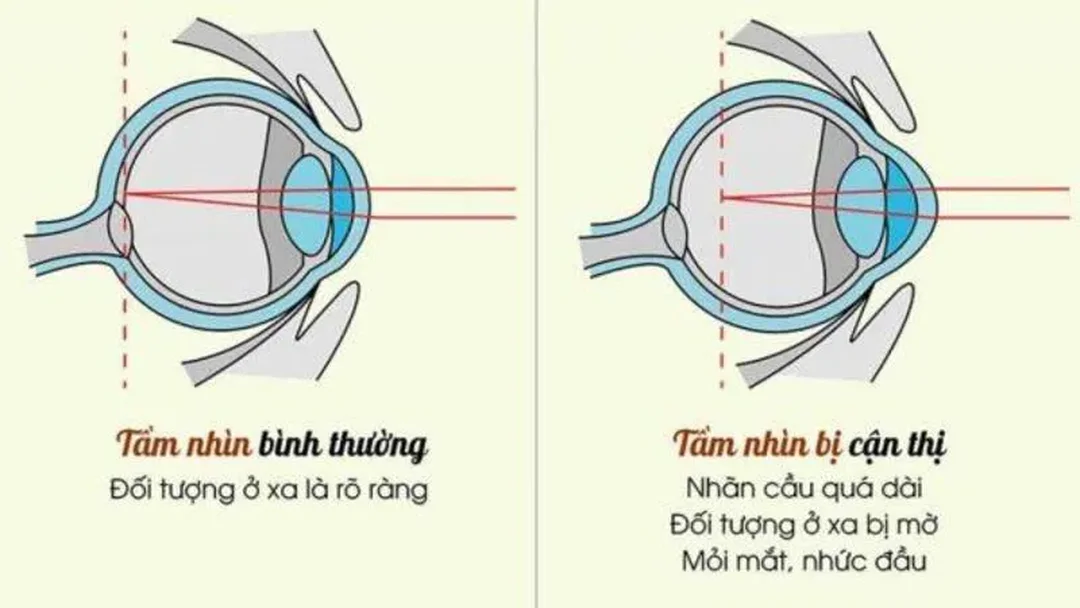 Giải pháp kiểm soát nguyên nhân của tật cận thị So sánh giải pháp kiểm soát nguyên nhân của tật cận thị