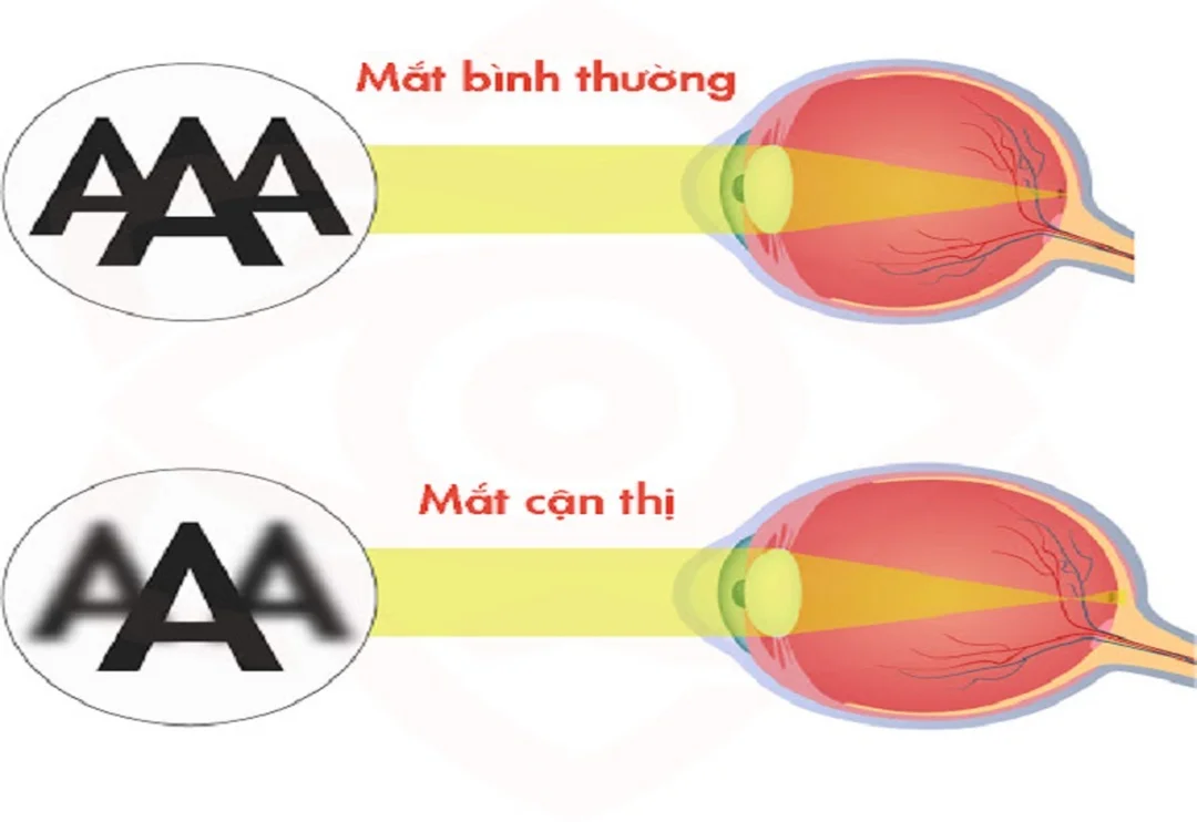 thế nào là tật cận thị do trẻ học lâu trong nhà và thiếu ánh sáng tự nhiên