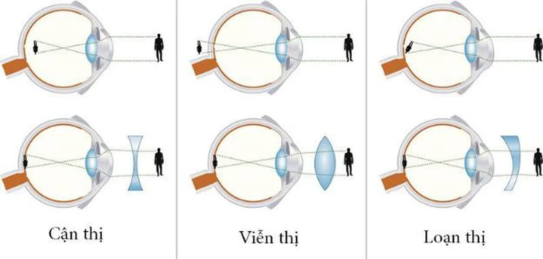 thế nào là tật cận thị ở trẻ có biểu hiện nheo mắt nhìn bảng