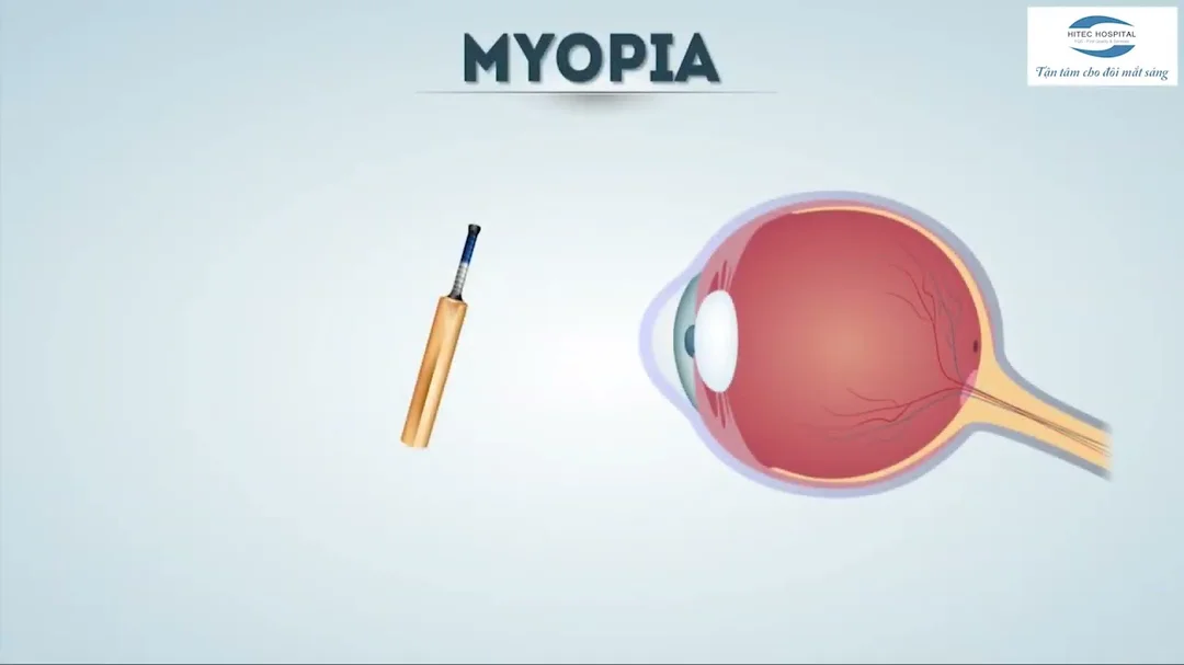 Video giải thích cận thị và viễn thị từ góc nhìn tật khúc xạ