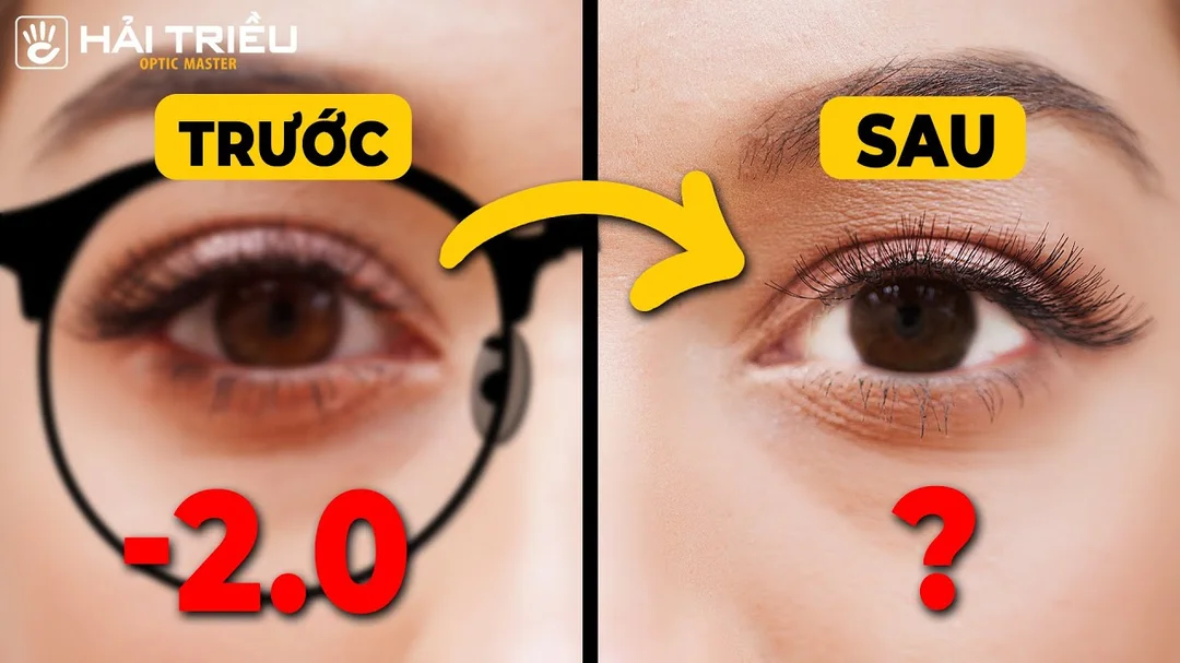 cách chữa cận thị nặng tại nhà dễ sai nếu tự bỏ kính hoặc tự dùng thuốc